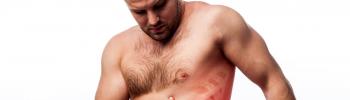 Síndrome de Tietze: ¿Qué es y cuál es su tratamiento? - FisioClinics Madrid Síndrome de Tietze: ¿Qué es y cuál es su tratamiento? - FisioClinics Madrid
