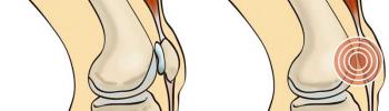 ¿Qué es la condromalacia patelofemoral? causas, síntomas y tratamiento de Fisioterapia
