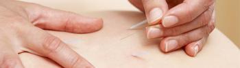 La Punción Seca en el tratamiento de la Fibromialgia - FisioClinics Madrid La Punción Seca en el tratamiento de la Fibromialgia - FisioClinics Madrid