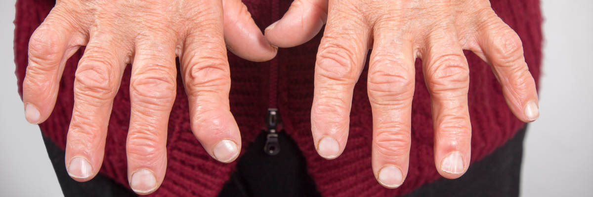 Fisioterapia para el manejo de la artritis: Estrategias de alivio del dolor y mejora de la movilidad