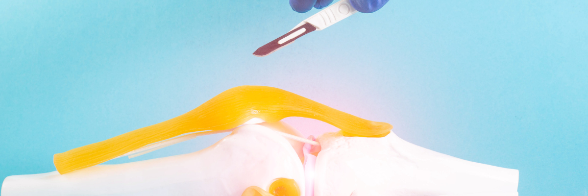 Cómo la fisioterapia puede ayudar en la rehabilitación después de una cirugía de rodilla