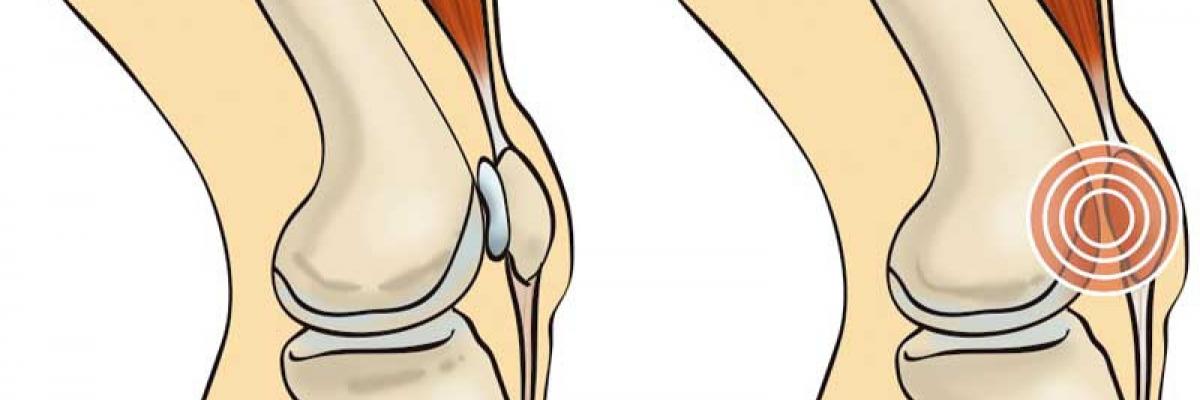 ¿Qué es la condromalacia patelofemoral? causas, síntomas y tratamiento de Fisioterapia