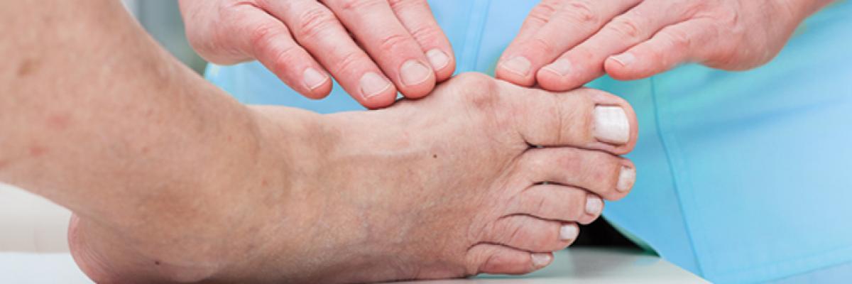 Abordaje fisioterapéutico para los juanetes