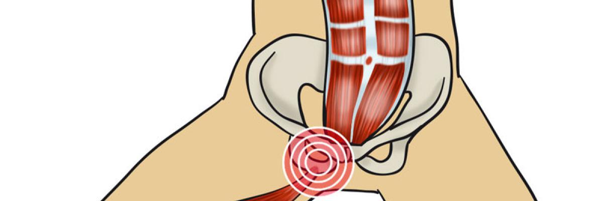 Osteopatía del pubis y su tratamiento en FisioClinics Madrid 