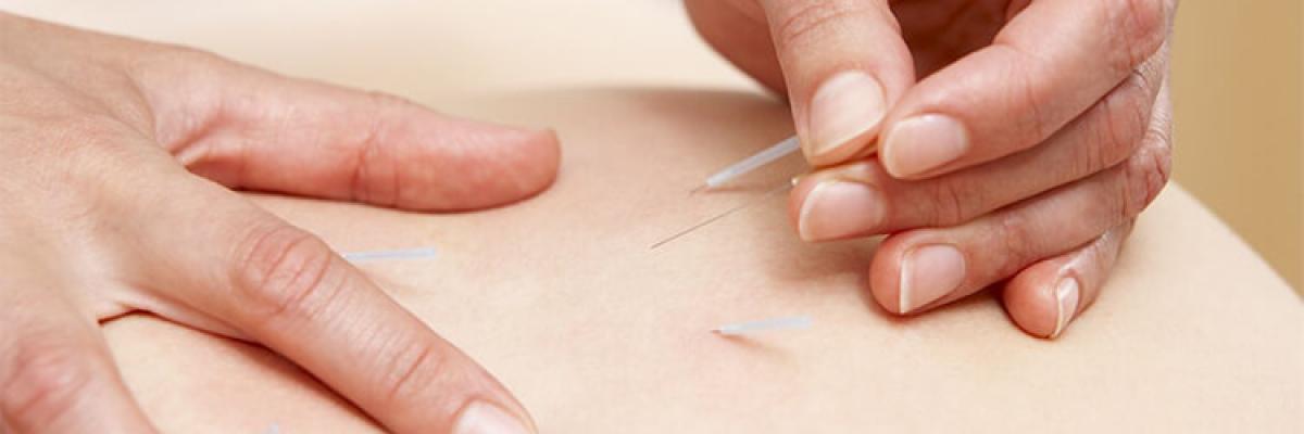 La Punción Seca en el tratamiento de la Fibromialgia - FisioClinics Madrid