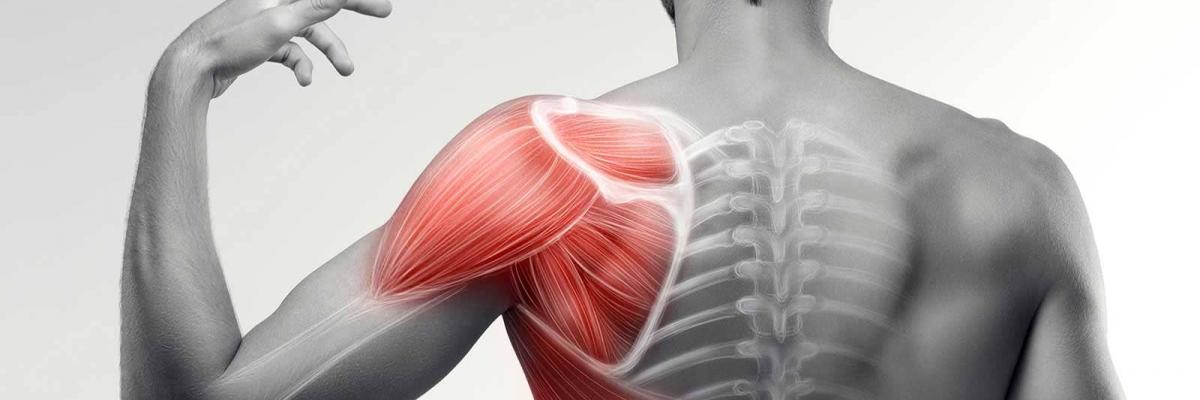 Tendinitis de hombro qué es, causas y tratamiento en FisioClincs Madrid 